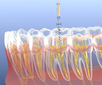 Endodontic root canal treatment process. Medically accurate Illustrazione stock
