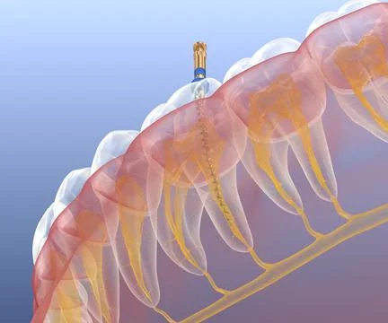 Endodontic root canal treatment process. Medically accurate Illustrazione stock