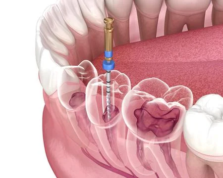 Endodontic root canal treatment process. Stock Illustration