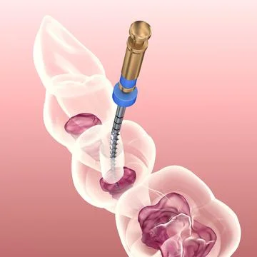 Endodontic root canal treatment process. Stock Illustration