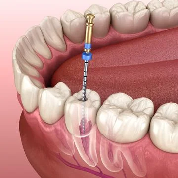 Endodontic root canal treatment process. Illustrazione stock