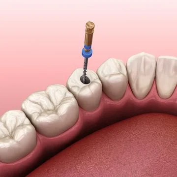 Endodontic root canal treatment process. Illustrazione stock