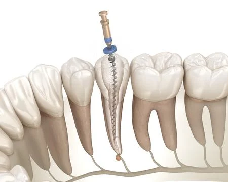 Endodontic root canal treatment process. Stock Illustration