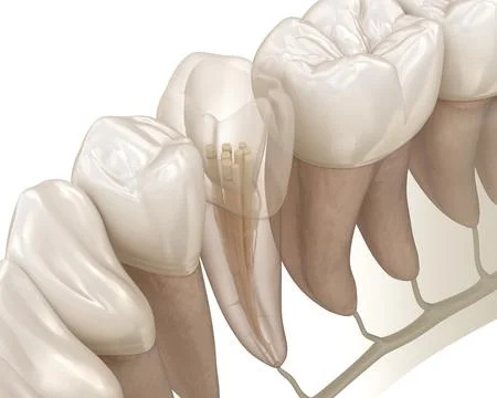 Endodontic root canal treatment process. Stock Illustration