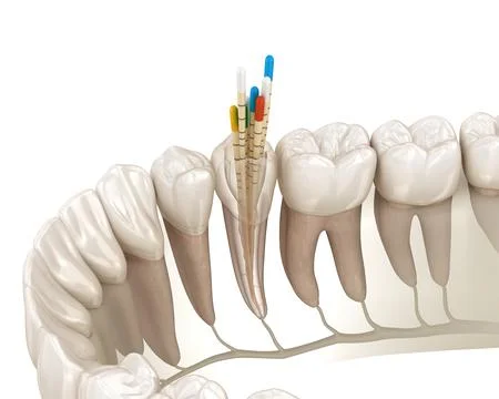 Endodontic root canal treatment process. Illustrazione stock