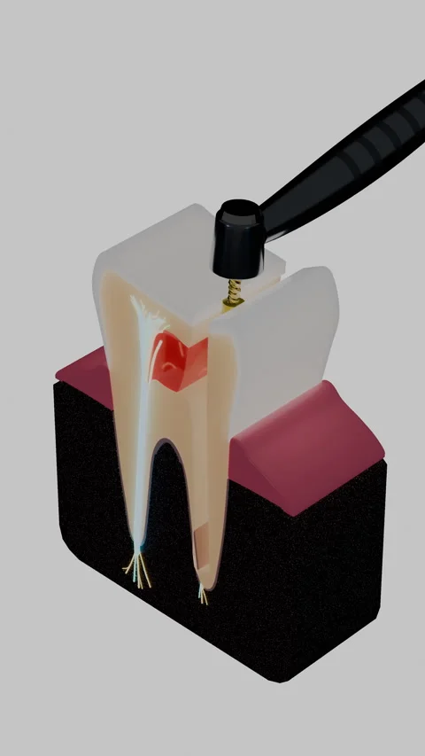 Endodontic rotary file cleaning molar root canal in vertical, Vertical 9:16 4K Stock Footage 346121488