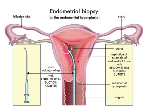 Endometrial biopsy 2 Stock Illustration