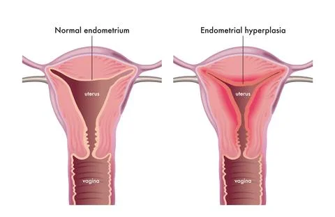 Endometrial hyperplasia Stock Illustration