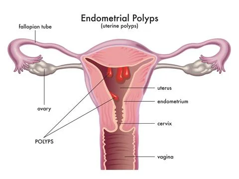 Endometrial polyps Stock Illustration