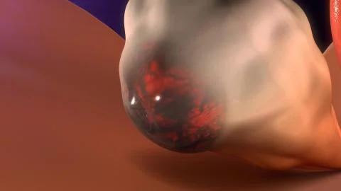 Endometrioma Stock Illustration