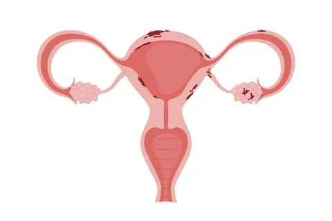 Endometriosis affecting uterus, fallopian tubes and ovaries Stock Illustration
