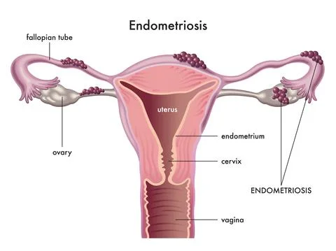 Endometriosis Stock Illustration