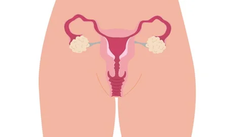 Endometrium dieases vector animation Stock Footage 346290173