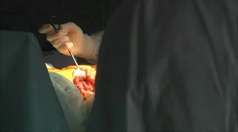 Endoprosthesis, sterile operating 4 Stock Footage