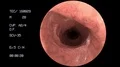 Endoscope medical camera gut intestine colon doctor endoscopy surgery 4k 4k or 4k+ Resolution