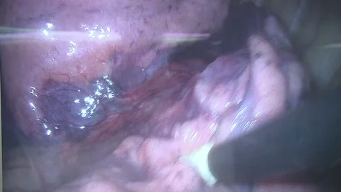 Endoscopic examination of a malignant tumor. Close up view through endoscopic Vídeo Stock 152091489