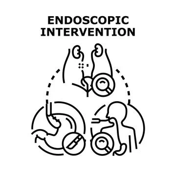 Endoscopic intervention concept illustrating internal organ examination. Diag Stock Illustration