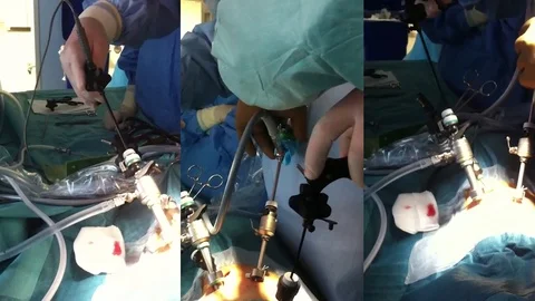 Endoscopic operation. Multicamera 库存影片 74215306