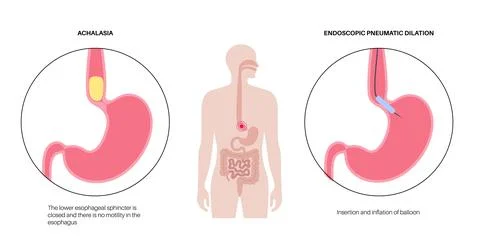 Endoscopic pneumatic dilation Illustrazione stock