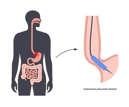 Endoscopic pneumatic dilation Stock Illustration