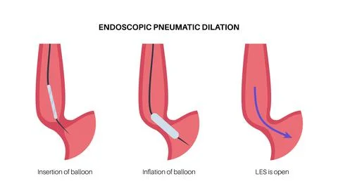 Endoscopic pneumatic dilation Stock Illustration