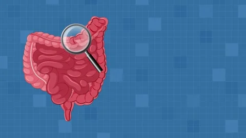 Endoscopic Polyp Removal Procedure in Large Intestine Animation Stock Footage 316364254