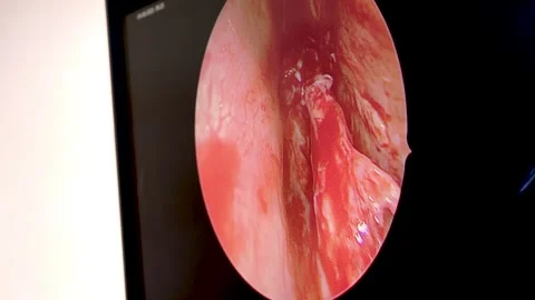 Endoscopic sinus surgery removing nasal polyps Stock Footage 316398982