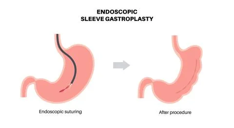 Endoscopic sleeve gastroplasty Stock Illustration