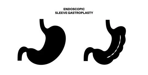 Endoscopic sleeve gastroplasty Illustrazione stock