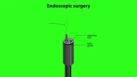 Endoscopic Surgical Procedure Animation with Labeled Instrument Components Stock Footage 316746017