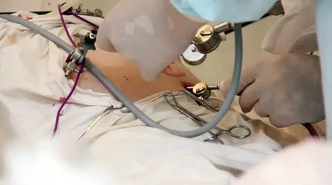 Endoscopy Stock Footage 22133413