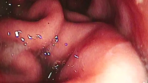 Endoscopy of gastric ulcer Stock Footage 130793828
