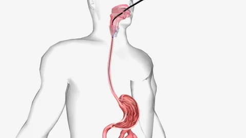 Endoscopy is a procedure that allows a doctor to view the inside of a person's Stock Footage 244531285