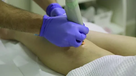 Endovenous laser coagulation Stock Footage 154586297