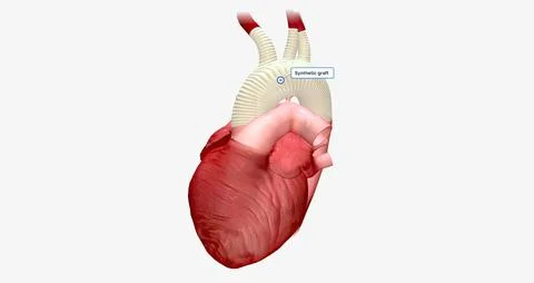 The enlarged portion of the aortic arch is replaced with a synthetic graft. 스톡 일러스트