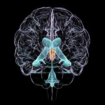 Enlarged third ventricle of the brain, 3D illustration Stock Illustration