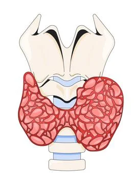 Enlarged thyroid gland affected by hyperthyroidism 2D vector illustration Stock Illustration