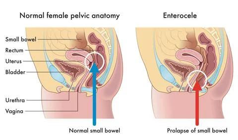 Enterocele Stock Illustration