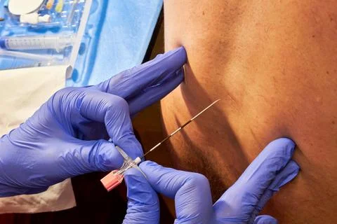 Epidural anesthesia Stock Photos