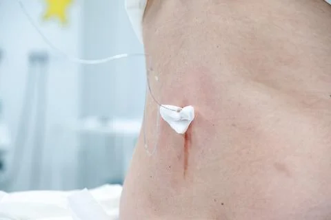 Epidural catheter inserted into patient's back, administering pain medicati.. Stock Photos