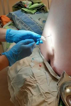 Epidural Catheter Insertion In Lower Back During Spinal Anesthesia Stock Photos