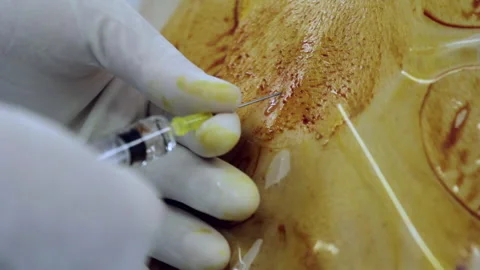 Epidural Stock Footage 239363668