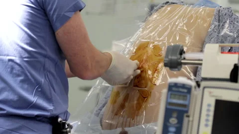 Epidural Stock Footage 239365598