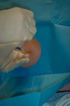 Epidural Needle Injection Foto stock