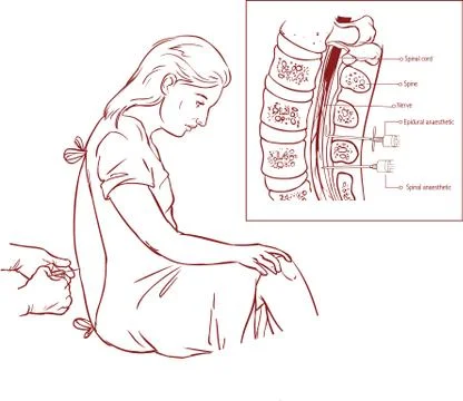Epidural Nerve Block Injection Stock Illustration