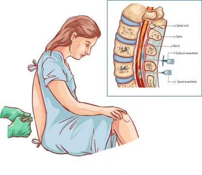 Epidural Nerve Block Injection Stock Illustration