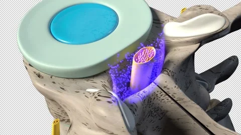 Epidural Steroid Injection 스톡 동영상 155358463