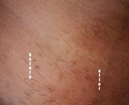 Epilation of the bikini area. Close-up of liquid wax hair removal. Shugaring Stock Photos