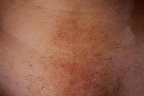 Epilation of the bikini area. Close-up of liquid wax hair removal. Shugaring Stock Photos