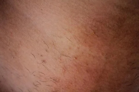 Epilation of the bikini area. Close-up of liquid wax hair removal. Shugaring Stock Photos